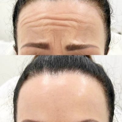 Anti-wrinkle Injections