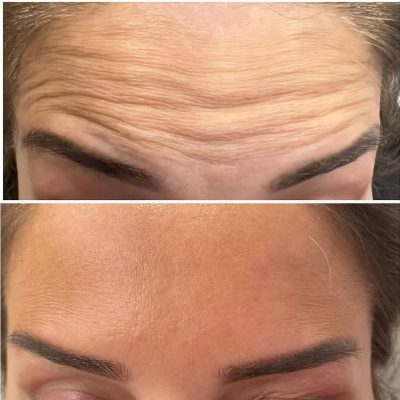 Anti-wrinkle Injections