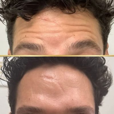 Anti-wrinkle Injections