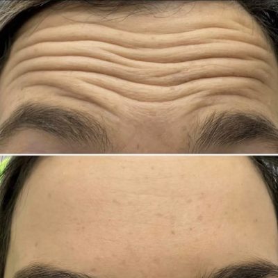 Anti-wrinkle Injections